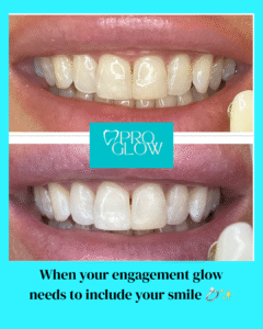 Before and after professional in office whitening -natural, pain-free results